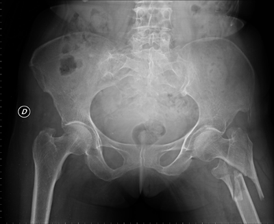 Osteoporosis